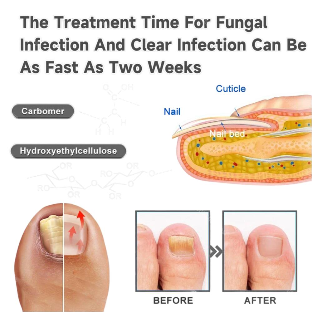 2 In 1 Fungal Nail Laser Device SUN