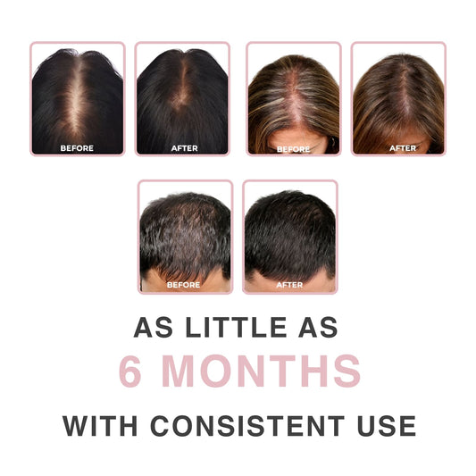 Before and after results using laser cap for hair growth UK after 6 months
